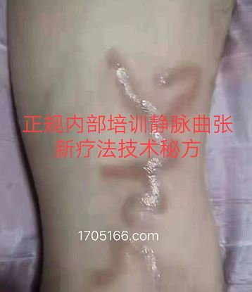 正规内部培训静脉曲张新疗法技术秘方