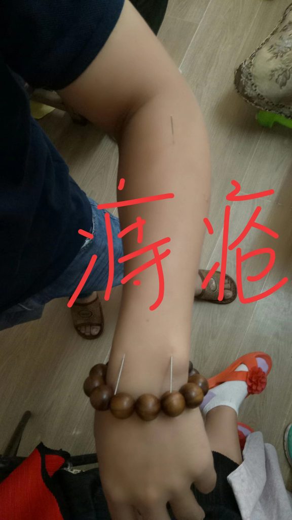 痔疮治疗视频技术