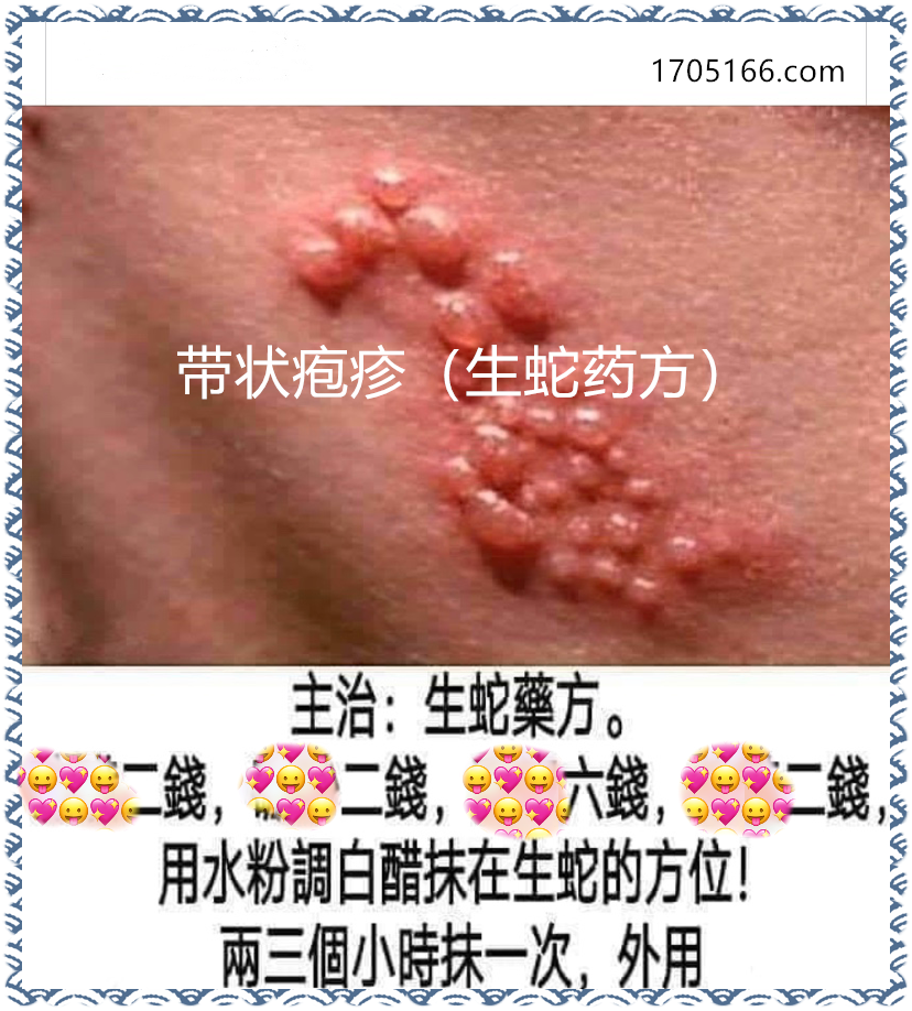 独家发布带状疱疹（生蛇药方）